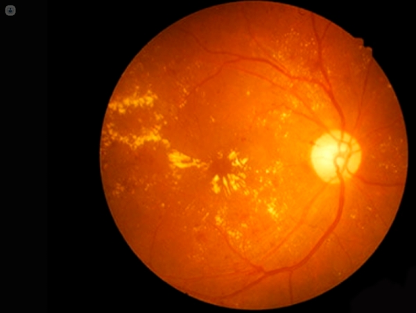 Le distrofie retiniche regmatogene: approfondimenti sull'occhio!