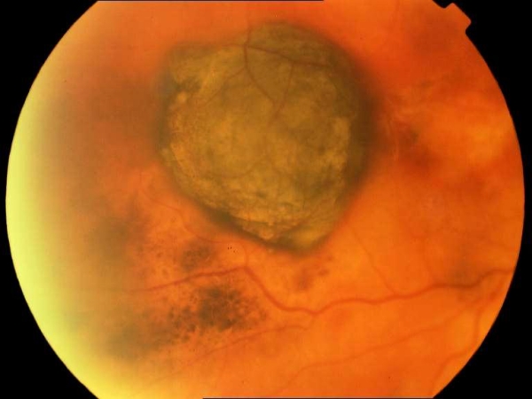 IL MELANOMA OCULARE
